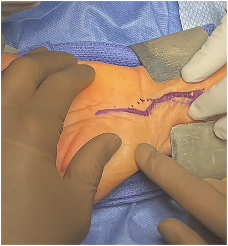 Figure 3. Intraoperative image of left wrist demonstrating a planned extensile approach (bold line) to the carpal tunnel.