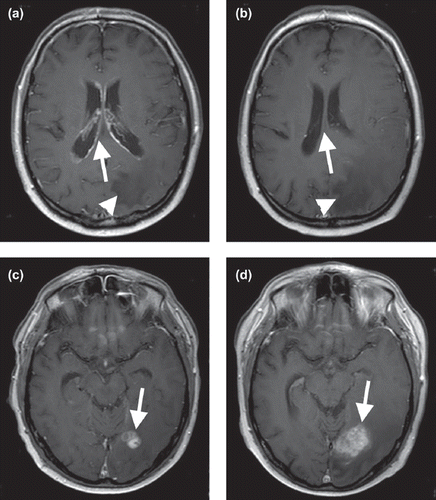 Figure 1a and c. Axial T1-weighted contrast-enhanced scans (3,0T, TR 550, TE 13) after radiochemotherapy but before treatment with adjuvant TMZ and intrathecal DepoCyte showing widespread subependymal enhancement (a, arrow), parenchymal metastases of the occipital lobe (c, arrow) with perifocal edema (a, arrowhead). b and d. Corresponding images (3,0T, TR 550, TE 13) 12 months later without evidence of leptomeningeal or subependymal lesions (b, arrow) while the cerebral parenchymal metastases (d, arrow) and the perifocal edema (b, arrowhead) increased in size.