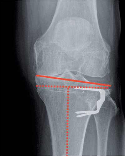 Figure 2. Example of intra-articular malalignment after high tibial osteotomy (WTO) with closing wedge technique. The solid red line indicates that the tibial plateau has been elevated medially and is not perpendicular to the tibial axis.