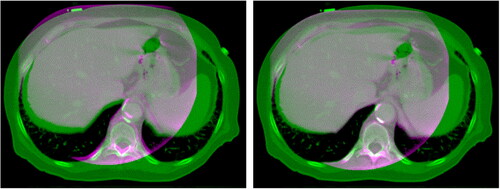 Figure 9. Overlay of corrected CBCT (pink) on pCT (green) before (left) and after (right) rigid registration. It can be seen that the registration was effective in the alignment of the bony structures. Each image is displayed with Window = 1300, Level = 0.