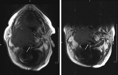 Figure 1.  MRI scan of the tumour before and after treatment with cetuximab and gefitinib. The arrows indicate the spinal cord.