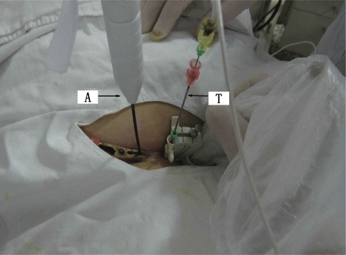 Figure 1. PMTA of uterine myoma was performed in a patient and the microwave antenna (A) and thermocouple needle (T) were inserted percutaneously into the target.