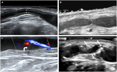 Figure 1. Ultrasound features of typical AVF lesions.(A) Type intima-dominant. Intimal hyperplasia at the proximal vein: distance shows the thickness of the intima (1.5 mm), and the minimum luminal diameter is 1.3 mm. The PSV at the stenosis site is 567 cm/s. (B) Type Non-intima-dominant: distance shows the thickness of intima (0.3 mm), and minimum luminal diameter is 1.7 mm. The PSV at the stenosis site is 592 cm/s. (C) Type Valve obstruction (In color mode). The valve is stiff, and the lead vascular lumen shows severe stenosis. The minimum luminal diameter is 1.0 mm. The white curved arrow points to the stiff valve. The PSV at the stenosis site is 534 cm/s. (D) Type vascular calcification. Vein calcification at venous outflow near the anastomosis, and the minimum luminal diameter is 0.8 mm. The PSV at the stenosis site is 511 cm/s. Sheet-like calcified plaques break into the lumen of the vessel and are hyperechoic. The white straight arrows point to calcified plaques. The border between intima and lumen is marked on the figures as dotted lines, * residual lumen, + intima. AVF: arterial-venous fistula; PSV: peak systolic velocity.