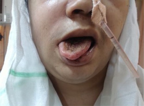 Figure 3 Deviation of tongue to the right (right hypoglossal nerve palsy).