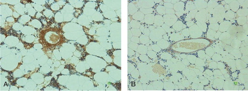 Figure 2.  A. Strong immunoreactivity found in both a marrow vessel and bone marrow cells. B. Weak immunoreactivity found in both a marrow vessel and bone marrow cells. Stain: anti-malondialdehyde monoclonal antibody (clone 1F83); magnification: ×200.