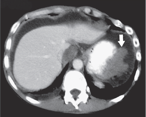 Figure 1. Contrast-enhanced axial CT image during the portal venous phase demonstrates the MPeM (arrow) located in the left upper quadrant of the abdomen. Please note the broad attachment of the tumor to the stomach.