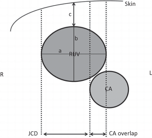 Figure 2. Anatomical illustration of study measurements. RIJV, right internal jugular vein; CA, carotid artery; JCD, jugular to carotid distance (safety margin); a, transverse diameter; b, anteroposterior diameter; c, depth from the skin; R, right; L, left.