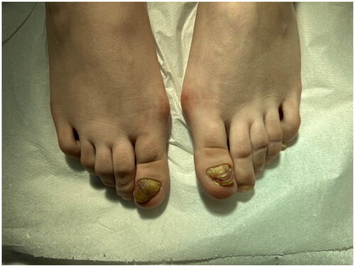 Figure 1. Onychogryphosis of the both great toenails. Thickening and lateral deviation of the toenails, resembling a ‘ram’s horn.’