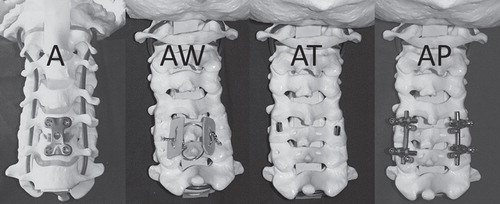 Figure 3. Various fixation methods as they were applied on the specimen mounted on plastic models. A = anterior plate alone; AW = anterior plate combined with posterior wire; AT = anterior plate combined with transarticular screws; AP = anterior plate combined with a pedicle screw–rod construct.