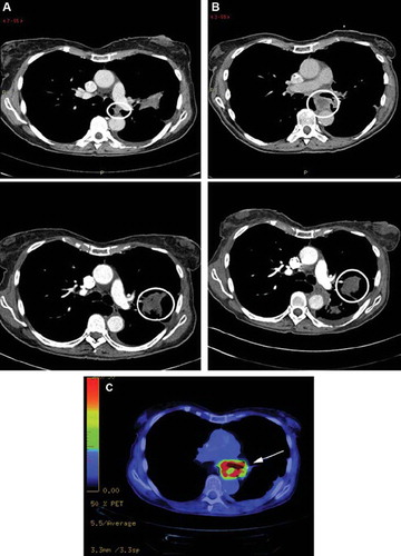 Figure 2. (A) Transverse CT image from July 3, 2008 in an 84-year-old woman with a tumor in the left upper lobe (lower picture; circle) shows soft tissue mass (upper picture; circle) between the left pulmonary artery and aorta descendens. (B) At three months after the therapy start, January 18, 2009, the primary tumor in the left upper lobe is slightly larger in volume but more confinable (lower picture; circle), whereas the lesion close to aorta descendens has become larger and necrotic (upper picture; circle). (C) 18F-FDG-PET scan from April 9, 2009 with a pathological uptake of 18F-FDG in the periphery of the expansion in front of descending aortae, but a low metabolic activity in the center of the lesion. No pathological uptake was found in the primary tumor in the left upper lobe.