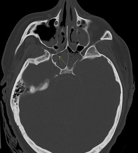 Figure 7 Axial view of the head CT. (Yellow arrow: right sided anterior sphenoid wall fracture due to force of penetrating trauma).