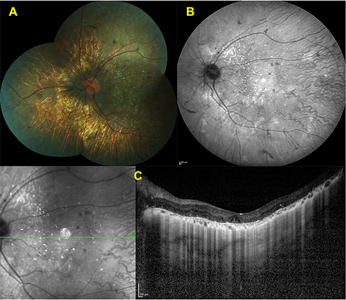 Figure 2 Features of advanced disease stage. Color fundus (A) and IR-R images. (B) of a left eye showing the marked diffuse chorioretinal atrophy and choroidal sclerosis with some pigment clumping areas. The horizontal SD-OCT section through the fovea (C) revealing the loss of EZ and RPE line with choroidal thinning.