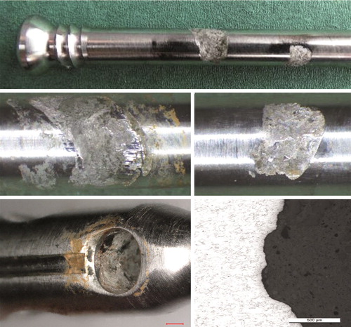 Figure 10. Mechanically assisted crevice corrosion/fretting and crevice corrosion at a locking screw, screw hole including microscopic image of the corrosion-attacked microstructure. For SEM imaging see Figures 12 and 13 in Supplementary data.