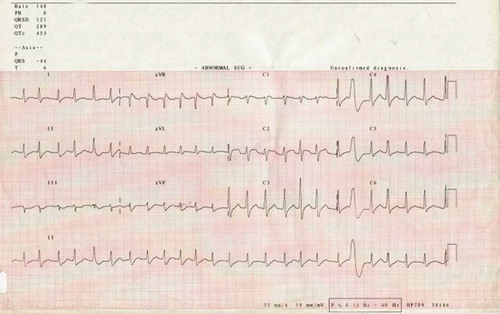 FIGURE 1.  ECG showing cardiac rhythm (atrial fibrillation) after initial cardioversion