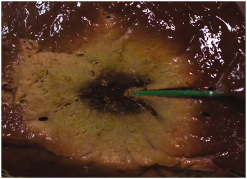 Figure 7. Sagittal cut of a liver sample along the MW antenna insertion plane after a MTA treatment (40 W, 10 min).