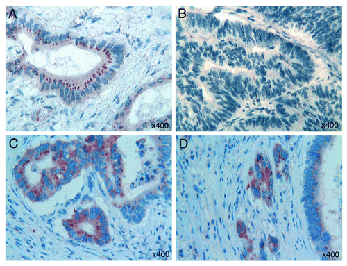 Figure 2. (A) A fine granular Tβ4 reactivity and a spot-like perinuclear Tβ4 immunostaining are observed in colorectal tumor cells with glandular arrangement. (B) Fine granular intraluminal immunoreactivity for Tβ4 is detected in less differentiated tumor areas. (C) Strong immunoreactivity for Tβ4 in the “budding margins” of colon cancer. (D) Strong cytoplasmic immunoreactivity for Tβ4 in isolated infiltrating tumor cells with features of epithelial-mesenchymal transition. OMx400.