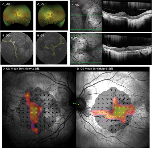 Figure 1. (a) Ultra-widefield optomap images of both eyes showing extensive retinal degeneration with choroidal atrophy consistent with choroideremia. (b) Short-wavelength autofluorescence imaging showing typical patterns of sharply demarcated areas of remaining hyperfluorescent tissue against atrophic retina giving an absent autofluorescent signal, with the following FAF areas on 55 degree images: right 7.65 mm2 ((OD) RE FAF) and left 13.90 mm2 ((OS) LE FAF). (c) Spectral-domain OCT scans showing ellipsoid zone shortening, intraretinal cysts and tubulations. Choroidal hypertransmission reveals the extent of RPE loss. (d) Right and left eye microperimetry sensitivity maps showing retinal sensitivities within the residual island of tissue.