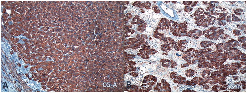 Figure 3. (A) Chromogranin-A and (B) Synaptophysin immunostaining on the tumor cells (IHC × 100, ×50).