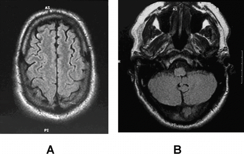Fig. 2.  MRI of the brain obtained 6 months after treatment with hyperbaric oxygen therapy for multiple air gas embolisms from concentrated hydrogen peroxide ingestion showing near complete resolution of previous defects in (A) cerebral cortex and (B) the cerebellum.