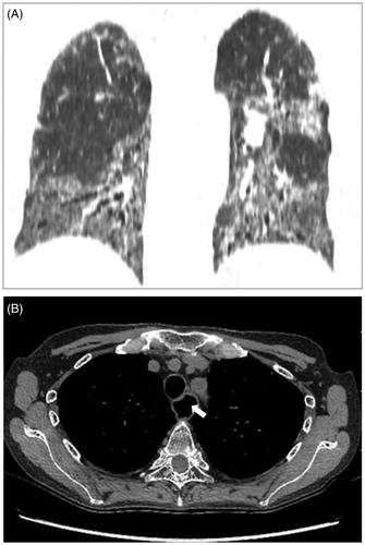 Figure 2. Chest CT images of a patient with SSc. The coronal view presents sclerotic change, especially in the lower lung field (A). The axial mediastinum setting presents enlarged esophagus on the left side of the trachea (white arrow) (B).