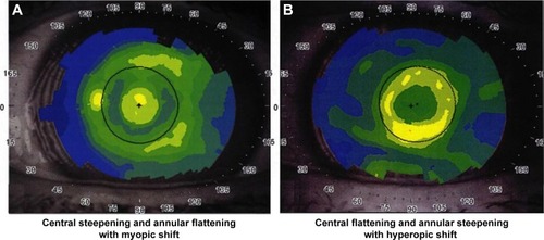 Figure 7 (A) Central steepening and annular flattening topography at 36 months in a patient with significant myopic shift. (B) Central flattening and annular steepening topography at 36 months in a patient with significant hyperopic shift.