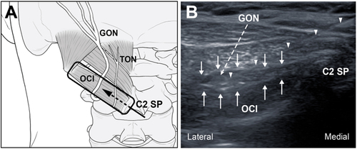 Figure 1 (A) Schematic diagram showing the probe position and needle direction for greater occipital nerve block. (B) Ultrasound image demonstrating needle placement and dye spread of GON block.
