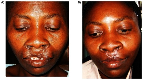 Figure 5 Surgical revision of bilateral cleft lip repair using fork flap technique: A) preoperative appearance; B) postoperative appearance.