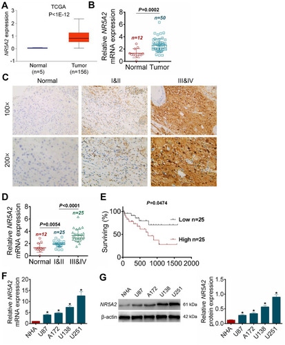 Figure 1 NR5A2 was highly expressed in glioma tissues and cell lines. (A) The data of NR5A2 expressions in 156 cases of glioma tumor tissues and 15 cases of adjacent nontumor tissues were harvested from TCGA database. (B) The NR5A2 mRNA expressions in 50 cases of glioma tissues and 12 cases of PTBE tissues were detected using qRT-PCR. (C) The NR5A2 expressions in different grades of glioma tissues and PTBE tissues were determined using IHC. (D) The NR5A2 expressions in different grades of glioma tissues and PTBE tissues were measured using qRT-PCR. (E) The 50 cases of glioma tissues were divided into NR5A2 high expression group and low expression group, the correlation between the survival rate of glioma patients and the expression of NR5A2 was assessed using Kaplan–Meier survival analysis. (F) The NR5A2 expression levels in human glioma cell lines (U138, U251, A172 and U87) and human normal astrocytes cell line (NHA) were analyzed using qRT-PCR. (G) The NR5A2 expression levels in human glioma cell lines (U138, U251, A172 and U87) and human normal astrocytes cell line (NHA) were evaluated using qRT-PCR. Data were shown as mean ±SD. *P<0.05 vs normal tissues or normal cell lines.