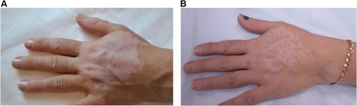 Figure 1 Patient A, area of vitiligo on the hands (A) before and (B) 2 weeks after treatment with NCTF135.