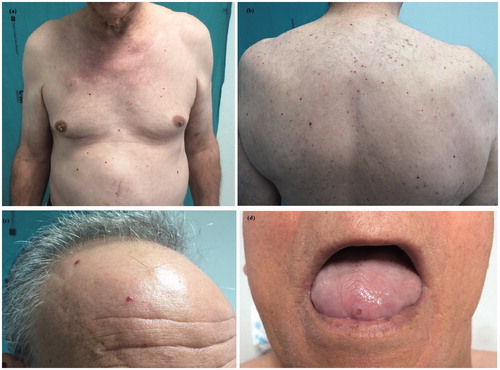 Figure 1. Multiple cherry angiomas on the chest and abdomen (a), back (b) and scalp (c). An eroded cherry angioma on the tongue (d).