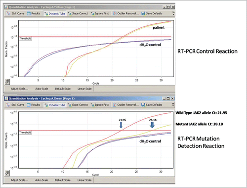 Figure 5. Real-Time Polymerase chain reaction (RT PCR) based JAK2 V617F mutation analysis of the patient. Upper graphic represents whether RT PCR has occurred. Lower graphic represents the presence of normal and mutant (V617F) allele of JAK2 mutation at DNA of biopsy drawn from skin lentigines of the patient. (TR PCR was done according to manucfacturer's instructions [JAK2 V617F mutation analyses kit, SNP Biyoteknoloji, Ankara, Turkey], using a Rotor Gene 2Plex [Qiagen, Hilden, Germany] and allelic discrimination analysis was done using Rotor Gene Q Series Software 2.1.0.