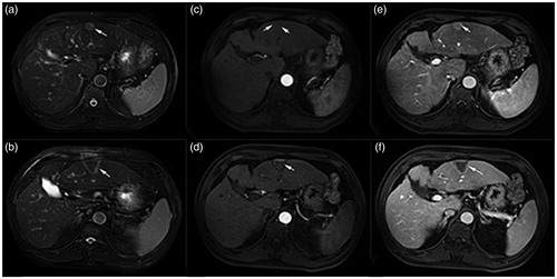 Figure 2. A 52-year-old male patient with HCC (lesion size: 17.97 × 17.19 × 16.41 mm) in the SonoVue group. By comparing the enhanced MRI images, the target region of lesion was coagulation necrosis and the tumor was completely ablated. (a) Before HIFU sonication, the lesion exhibited slightly hyperintense on the T2WI; (b) After HIFU sonication, the slightly hyperintense of lesion turned into hypointense on the T2WI; (c) The lesion was not enhanced on the T1WI in arterial phase before treatment; (d) The lesion was not enhanced on the T1WI in arterial phase after treatment; (e) An obvious enhancement of lesion was exhibited on the T1WI in the portal vein phase before treatment; (f) The postoperative lesion without enhancement showed a dark space on the T1WI in the portal vein phase.