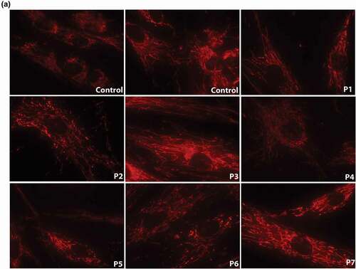 Figure 2. Mitochondrial network visualization and quantitative analysis of mitochondrial density (MD) and branching factor (BF) in fibroblasts of 7 HD patients (P1 – P7) and 4 controls. a) Native dying of mitochondrial network in fibroblasts of HD patients P1-P7 and 4 controls: Cultivated skin fibroblasts were visualized in 10 nM MTR (MitoTracker RED, Molecular probes, Eugene, OR) 15 min at 37°C. Unequal distribution of mitochondrial network and mild fragmentation were detected in all 7 patients in comparison to controls, although the level of disruption was different in different lines. Original magnification: 600x. b) Mitochondrial density (MD) and Branching factor (BF) analysis in mitochondrial network in fibroblasts of 7 HD patients (P1 – P7) and 4 controls. quantitative analysis was provided in Fiji program. T-test was used for statistical analysis. MD and BF were significantly decreased in patient´s cells compared to controls (p = 0.0051) (p = 0.014),respectively.b)