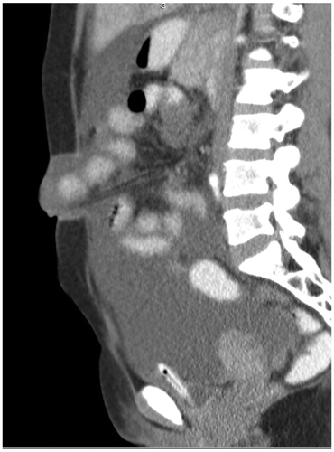 Figure 1a: Sagittal post-contrast CT showing an umbilical hernia with herniation of small bowel loops through a midline defect in the abdominal wall