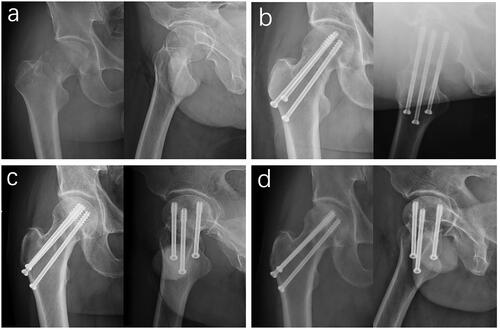 Figure 3. Preoperative anteroposterior and lateral hip X-rays of a 40-year-old male patient with Right femoral neck fracture treated with CCS. (a) Preoperatively. (b) Postoperatively after 2 days. (c) Postoperatively after 6 months. (d) Postoperatively after 1 year.