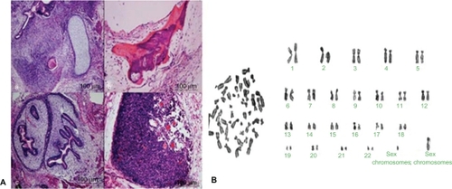 Figure 4 A) Histological analysis of teratomas formed from grafted colonies of induced pluripotent stem cells in severe combined immunodeficient mice: a) Neural ganglia and supporting cartilage; b) bone and smooth muscle; c) submucosa glands; d) neural epithelium. B) G-banding chromosome analysis of induced pluripotent stem cells.