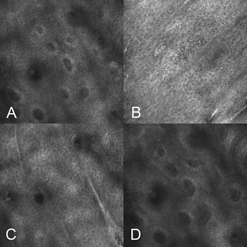 Figure 4 RCM features of PD patient after treatment (A) Vascular dilation and congestion were improved. (B) No pigmentation in the epidermis. (C) No obvious edema in the spinous layer. (D) No inflammatory cells were detected in the dermis.