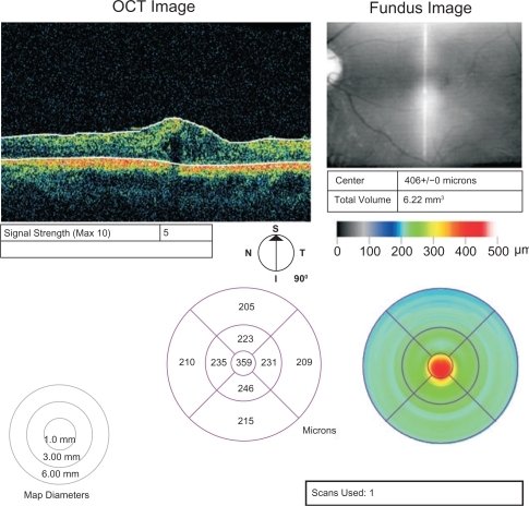 Figure 2 Central foveal thickness after the third intravitreal bevacizumab injection.