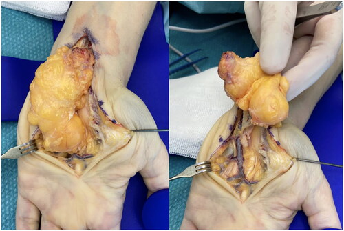 Figure 3. Intra-operative photographs of lipoma recurrence.