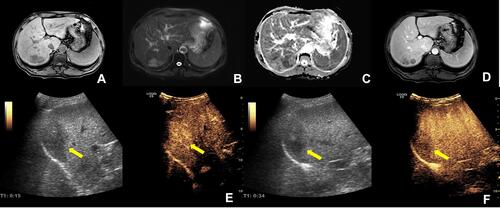 Figure 1 A space-occupying lesion of approximately 41×51 mm was found in the right posterior lobe of the liver (indicated by arrows). Gadolinium ethoxybenzyl diethylenetriamine pentaacetic acid-enhanced MRI findings: (A) T1-weighted image, (B) T2-weighted image, (C) ADC map, (D) enhanced image. Contrast-enhanced abdominal ultrasound imaging findings: (E) arterial phase and (F) portal phase.