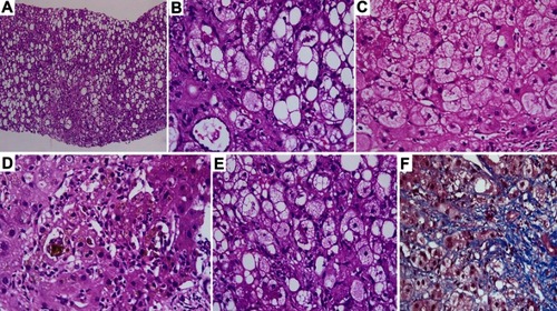 Figure 4 Histopathology of alcoholic hepatitis. (A) Severe macrovesicular steatosis (haematoxylin and eosin stain, H&E, 40×). (B) Ballooning of hepatocytes (Masson-trichrome stain [MTS], 20×). (C) Foamy degeneration of alcoholic hepatitis (H&E, 40×). (D) Severe cholestasis of alcoholic hepatitis associated with foamy degeneration (H&E, 40×). (E) Mallory-Denk bodies seen in a patient with alcoholic hepatitis (H&E, 40×). (F) Chicken-wire or pericellular fibrosis of alcoholic hepatitis (MTS, 40×).