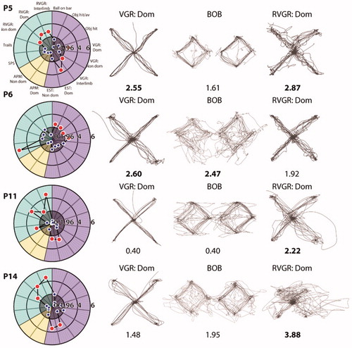 Figure 2 Example patient performance on robotic assessment tasks. Each row displays Task Scores for four example participants and hand paths for three tasks. Task Scores are written underneath each task and are indicated as impaired (bold) when appropriate. ‘Dom’ denotes dominant hand and ‘Non-dom’ denotes non-dominant hand.