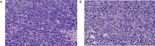 Figure 8.  Morphological changes of H22 tumor cells treated with HE staining (×200). The transplanted tumors in the group of negative control (A) and Aikete injection 2.0 mg/kg (B) were exercised for HE staining and observed under microscope.