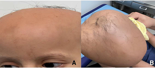 Figure 1 Diffuse alopecia with few terminal hairs. (A) Fronal view, (B) Vertex view.
