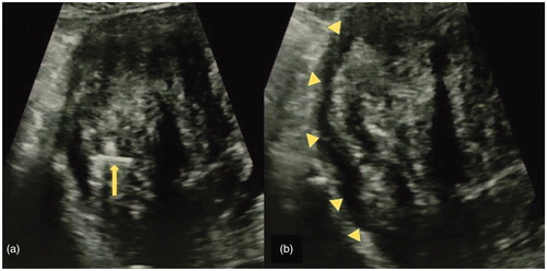 Figure 3. (a) Ultrasonic findings before injection of a dilute vasopressin solution (percutaneous transabdominal cholangiography [PTC] needle). (b) After injection of a dilute vasopressin solution into the space between the myometrium and surface of the leiomyoma using a 21-G PTC needle under transabdominal ultrasound guidance, a hypoechoic lesion into the myometrium was visualized (Δ dilute vasopressin solution).