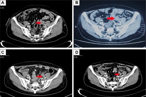 Figure 1 Pelvic CT shows the lymph node metastasis. (A) Before therapy (August 17, 2015). (B) Before therapy (October 22, 2015), the lymph node was bigger than 2 months earlier. (C) After 3 months of apatinib treatment (March 7, 2016), the lymph node was smaller than 4 months earlier. (D) After 9 months of apatinib treatment (August 30, 2016), the lymph node was smaller than 5 months earlier. Red arrows indicate the lymph node metastasis.