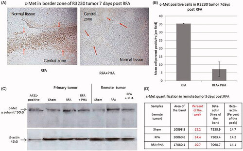 Figure 2. PHA reduces post-RFA c-Met expression in the periablational rim. (A) Immunohistochemical staining for c-Met receptor demonstrating c-Met expression in RFA periablational rim (arrowheads) vs. RFA with PHA 7 days post treatment. PHA addition to RFA reduces significantly c-Met expression (to minimal expression – arrowheads) compared to RFA alone. (B) Bar chart quantifying this infiltration of c-Met receptor + cells into the tumoral periablational rim 7 days post RFA. There is a significant reduction of c-Met positive cells in tumor tissue post RFA treated with PHA compared to RFA alone. (C,D) Western blot assays demonstrate increased c-Met receptor protein in the periablational tissue surrounding the ablation zone from pooled samples compared with sham treatment (seen as dense bands after gel electrophoresis at 50-kDa level, where the c-Met receptor a subunit is expected, after b-actin standardization). c-Met receptor protein levels are also increased in the distant untreated tumor after RFA compared with sham treatment. Addition of PHA reduces c-Met receptor protein levels in both local and distant tumor. (A431: Positive control; ST: Sham tumor; RFT: RFA tumor; RPT: RFA + PHA tumor; SRT: Sham remote tumor; RFRT: RFA remote tumor; RPRT: RFA + PHA remote tumor).