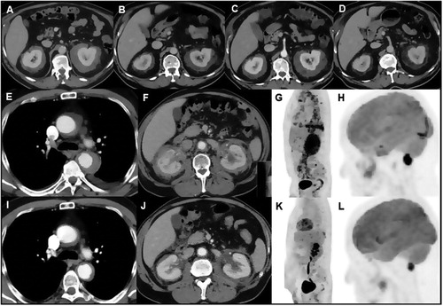 Figure 2. Response to treatment assessed by repeated contrast-enhanced CT scanning in case 2. Abdominal CT scan at presentation (A) and after 6 months of sirolimus (SRL) treatment showed a marked decrease in size and density of the bilateral perirenal soft tissue mass (B). Repeat CT scan 6 months after self-discontinuation of SRL treatment, 8 months after the first follow-up CT scan, showed an increase in size and density of the bilateral perirenal mass (C). Repeat CT scan 6 months after reinstituting SRL treatment again showed a marked decrease in size and density of the bilateral perirenal mass (D). Response to treatment assessed by different imaging modalities in case 3. Thoraco-abdominal CT scan performed at presentation (E,F) and after 6 months of SRL treatment showed a marked decrease in size of the periaortic (I) and perirenal (J) soft tissue mass. 18FDG-PET scan at presentation (G,H) and after 6 months of SRL treatment showed disappearance of 18FDG-uptake at the level of the thoracic (aortic arch) and abdominal aorta, pleuropericardium and bilateral perirenal mass (K) and marked decrease of/disappearance in 18FDG-uptake at the level of the pons and extra-axial lesion near the foramen magna (L), respectively.