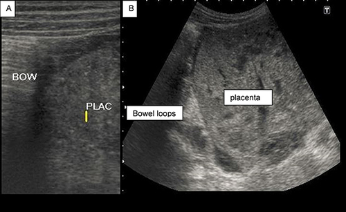 Figure 5 Picture showing relation of the placenta with bowel loops on a linear (A) and curvilinear (B) transducer probes.