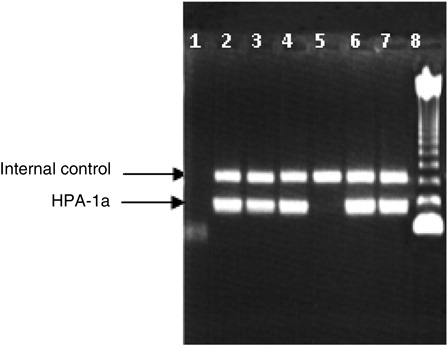 Figure 1. Examples of amplification in HPA-1a system. The upper band corresponds to the amplification product of the CRP gene (internal control of 440 bp). The lower band corresponds to the amplification product of HPA-1a gene (189 bp) situated between 123 and 246 bp bands of molecular weight markers.Lane1: negative control; lanes 2, 3, 4, 6, and 7: individuals with HPA-1a allele; lane 5: individual without HPA-1a allele; lane 8: molecular weight marker of 123 bp.
